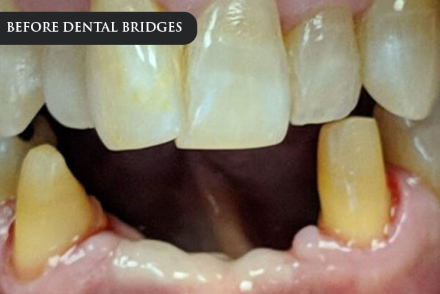 a before treatment image of a patient missing multiple teeth
