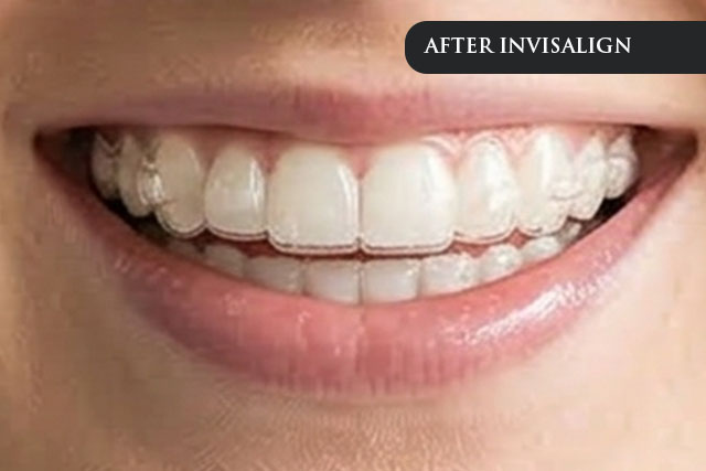 an after treatment image of a patient after wearing invisalign
