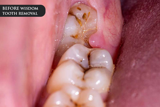a before treatment image of a patient with abnormal wisdom tooth growth